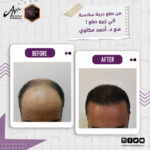 ما هو البديل عن زراعة الشعر؟